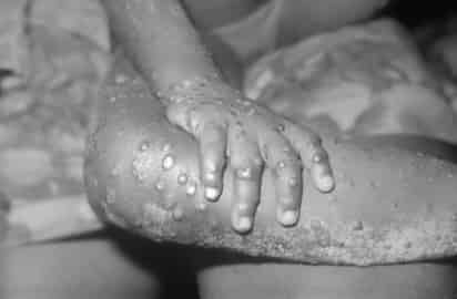 Este viernes se reportó un caso de viruela de mono en un residente de Texas, quien había volado a Atlanta desde Nigeria el 8 de julio, con destino final el aeropuerto Dallas Love, informaron los Centros para el Control y la Prevención de Enfermedades (CDC, por sus siglas en inglés). (ESPECIAL)