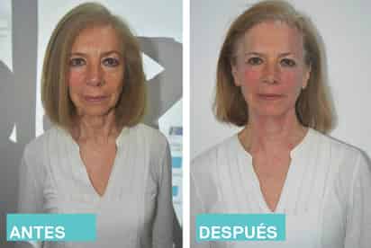 El Ultraformer es uno de los procedimientos más efectivos que pueden ayudar a esta piel a recobrar su calidad y belleza. (ESPECIAL)