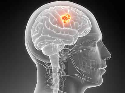 El cáncer no es solo un tumor, sino el tumor y su contexto y este nuevo sistema, denominado METPlatform, permite investigar con muestras de pacientes en un contexto real, en el que las células metastásicas crecen en el microambiente tumoral que las rodea, en este caso el cerebro. (ESPECIAL)
