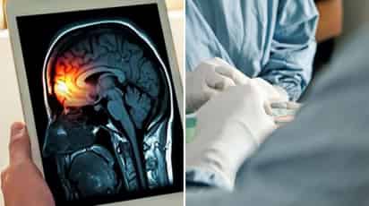 Quienes presentan síntomas de meningitis deben acudir a un médico de inmediato. (ARCHIVO)