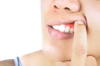 Gingivitis, primera etapa de la caída de dientes