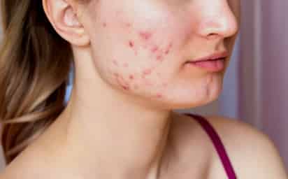 Descubre la mejor vitamina para combatir el acné