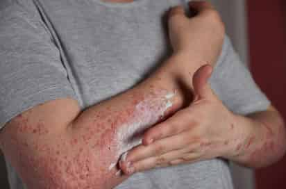 Identificada una mutación genética responsable de la psoriasis