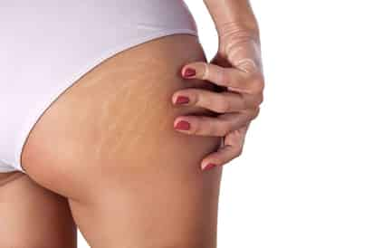 Celulitis (ESPECIAL)