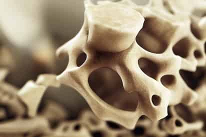 Osteoporosis.