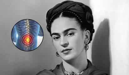 ¿Qué es el síndrome de la cola de caballo que padeció Frida Kahlo? 