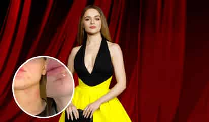 Joey King sufre quemaduras en el rostro en accidente