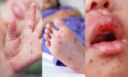 ¿Ardor y dolor? Puede ser la enfermedad pie-mano-boca