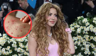 Alertan por posible exposición de sarampión en concierto de Shakira