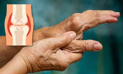 Cuidado con la artritis: ¿cómo evitarla?