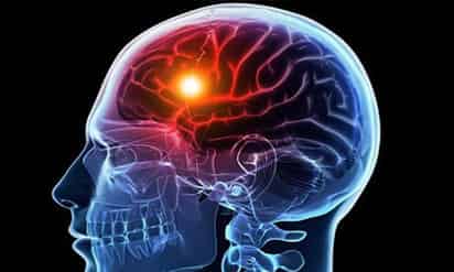 Los infartos cerebrales impactan a mexicanos cada vez más jóvenes, alerta un especialista