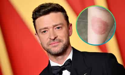 Justin Timberlake revela que padece la enfermedad de Lyme ¿Qué es?