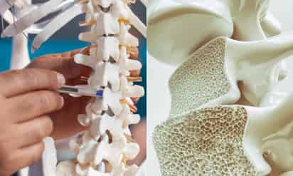 Mitos: osteoporosis y tercera edad