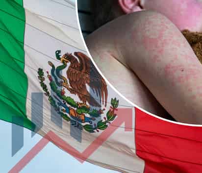 Ya se han registrado casos de sarampion en 21 estados de México. [Especial]