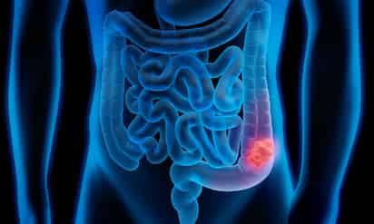 Estudio suizo detecta cáncer colorrectal mediante bacterias presentes en el intestino
