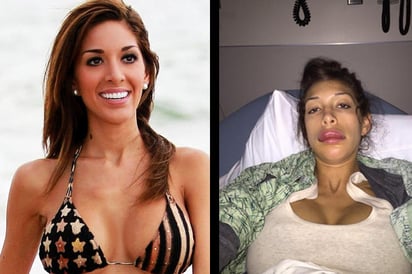 Farrah tuvo complicaciones con su operación y para muestra su rostro, el cual quedó desfigurado. (INTERNET)