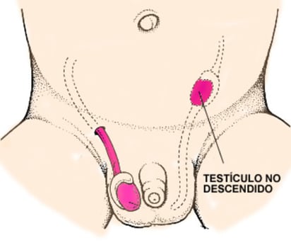 Un paciente con criptorquidia en un solo testículo tiene un riesgo de 75 por ciento de infertilidad. Si el problema es bilateral y se corrige la criptorquidia, el riesgo es de 50 por ciento. (INTERNET)