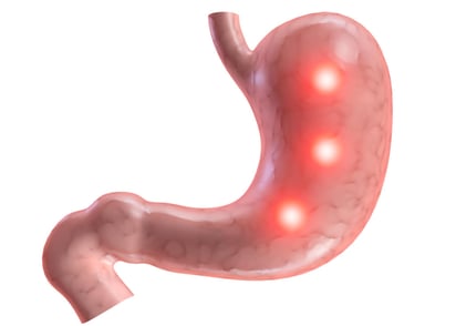 El trabajo analizó los datos de 2,022 pacientes diagnosticados con adenocarcinoma gástrico entre 2004 y 2016, de los cuales 290 eran menores de 40 años. (ARCHIVO)