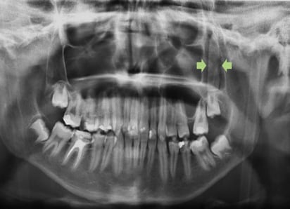 Joven de 14 años se incrustó el cristal de 3.5 centímetros tras desmayarse y golpear una ventana. (INTERNET)