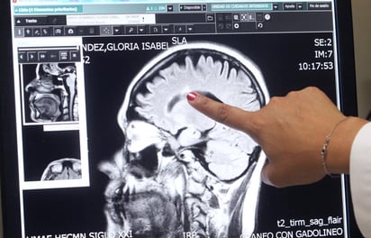 La esclerosis múltiple (EM) es una enfermedad autoinmune del cerebro y la médula espinal (sistema nervioso central), que puede provocar discapacidad neurológica no traumática en los adultos jóvenes. (ARCHIVO) 