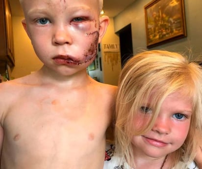 Bridger, al ver que su hermana era atacada por un can, no dudó y se interpuso entre ambos, recibiendo algunas heridas en el rostro con las cuales quedó a pocos centímetros de perder el ojo. (CAPTURA) 