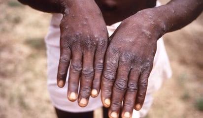 ¿Cuáles son los síntomas de la Mpox? La enfermedad declarada emergencia mundial por la OMS