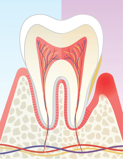 Las bolsas periodontales son resultado de la inflamación y separación del diente de los tejidos que lo rodean 