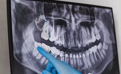 Con la evolución, la muela del juicio es una pieza dental que tiende a desaparecer. Foto: Cortesía