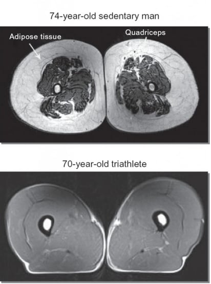 Sección trasversal del cuádriceps de un  sedentario de 74 años (arriba) y un hombre triatleta de 70 años (abajo). Foto: cortesía