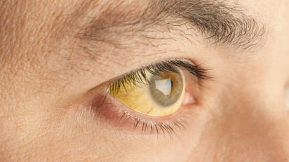 Un signo de que algo anda mal con el hígado es la ictericia (color amarillento en la piel y ojos). Foto: GettyImages