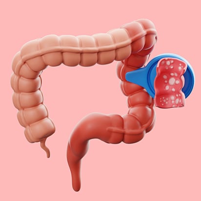 Imagen: Freepik Las nitrosaminas son compuestos que dañan las células del sistema digestivo y pueden causar cáncer. 