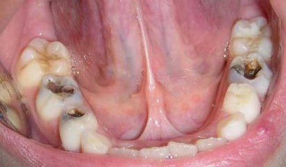 La boca puede ser una puerta de entrada para virus y hongos, como el herpes y la candidiasis, que pueden causar infecciones en otras partes del cuerpo. Foto: especial