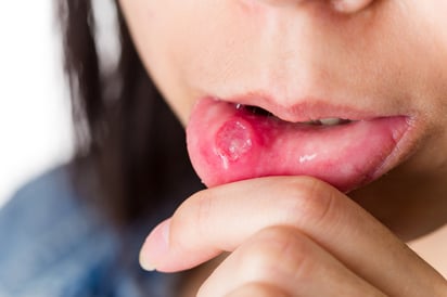 Imagen: Adobe Stock. La herpes bucal no suele provocar encefalitis, pero cuando
lo hace llega a causar daño cerebral.