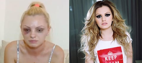 La cantante rumana Alexandra Stan, reconocida por su éxito “Mr. Saxobeat” fue víctima de violencia por parte de su novio y agente quien la agredió físicamente dejando su rostro con fuertes lesiones.