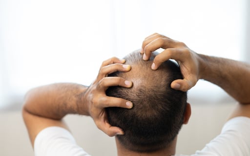 Imagen La mejor manera de manejar las emociones al perder el cabello