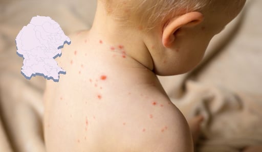 Imagen Coahuila ocupa el tercer lugar con más casos de sarampión en México