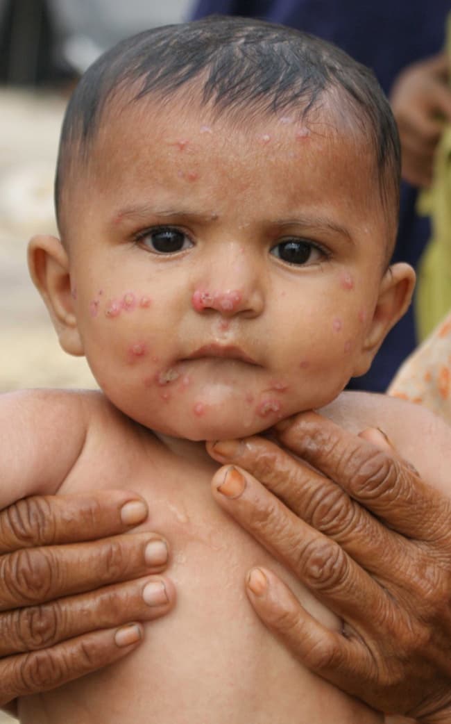 Científicos australianos hallaron que los niños con una insuficiencia de vitamina D tenían tres veces más de probabilidades de sufrir alergias a los alimentos. ARCHIVO