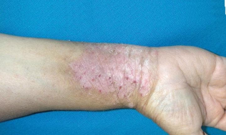 La psoriasis es una enfermedad autoinmune, “el organismo tiende a agredirse a sí mismo, en este caso, produce células inflamatorias de manera incontrolada”, detalla una experta. INTERNET