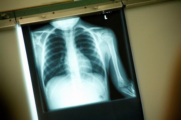 Ahora el uso de los Rayos X es común en la medicina. (ARCHIVO)