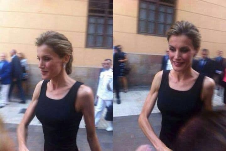 Se dice que padece anorexia.