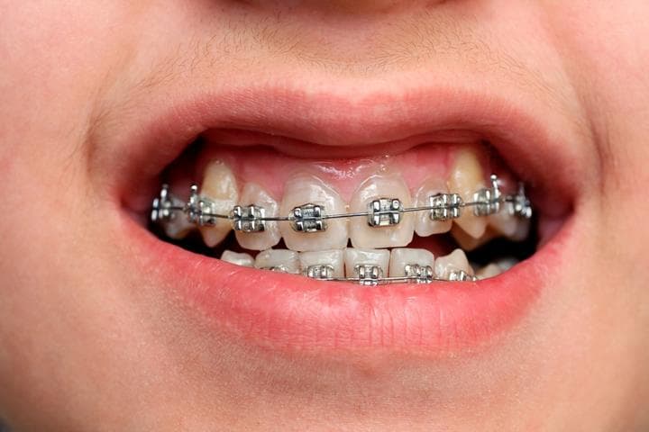 Por los componentes de los sistemas de adhesión, al desprender los brackets pueden causar microfracturas, acumulación de placa bacteriana y a veces caries. (ARCHIVO)