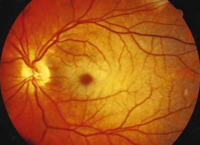 El padecimiento, causa de ceguera, es una obstrucción del flujo de sangre, en la parte posterior del ojo, que provoca que las paredes de la vena central dejen escapar sangre y fluidos dentro de la retina.