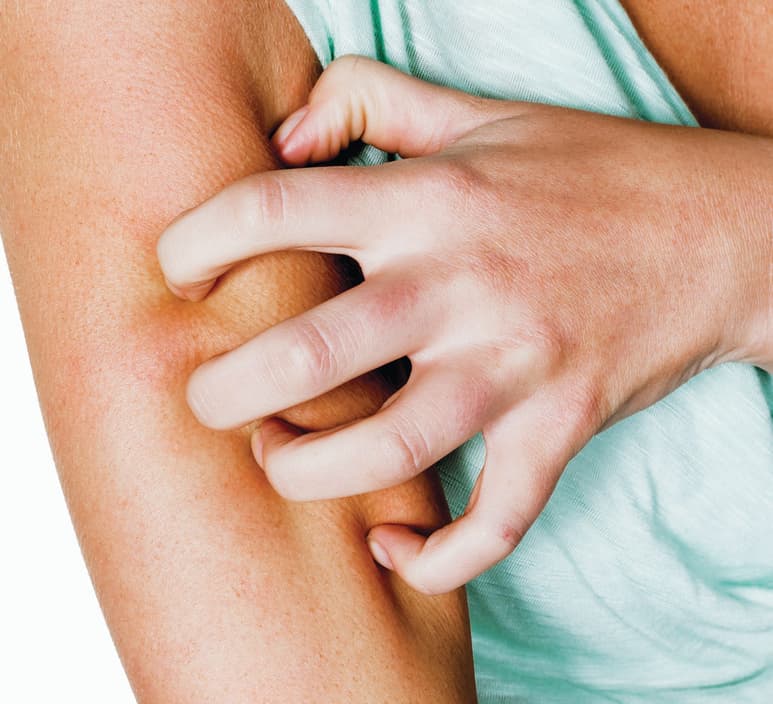 Dermatitis atópica
