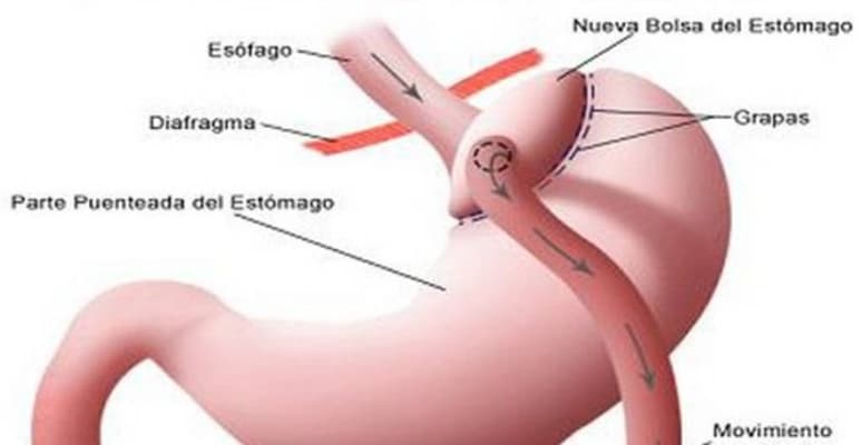Cirugía. Más de cinnco millones de niños en México tienen un problema de obesidad o sobrepeso.