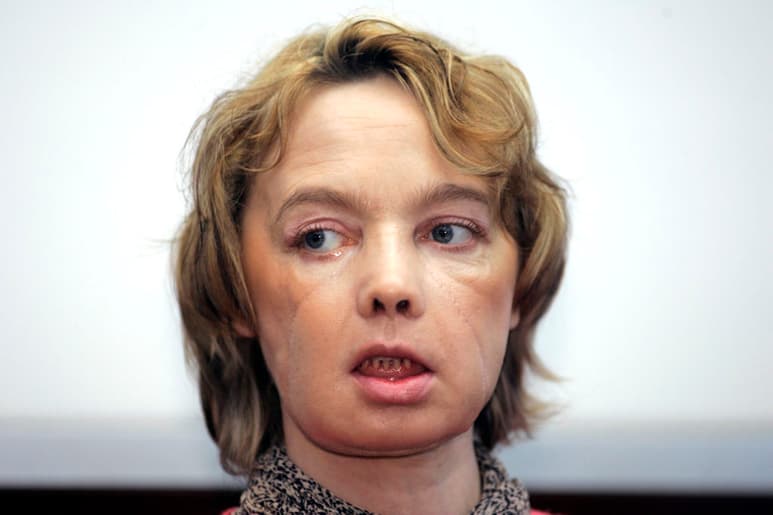 Dinoire había perdido los labios, parte de la nariz y la barbilla al ser atacada por su perra en mayo de 2005. (AP)