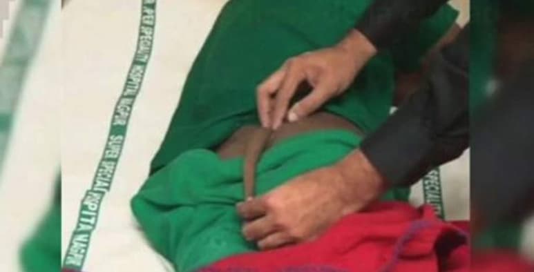 El joven llevaba ocultando la protuberancia toda su vida. (INTERNET)