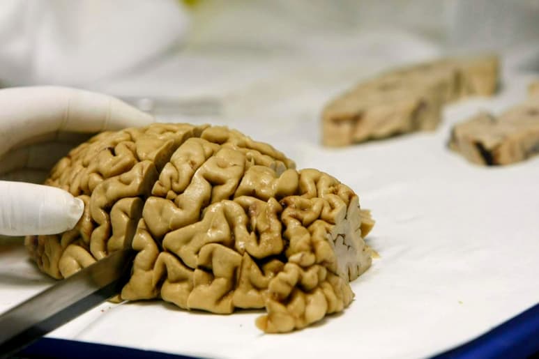 La pesquisa muestra como una célula en el cerebro afectada por alzheimer se recupera parcialmente cuando se aplica la proteína TGF beta 1. (ARCHIVO)