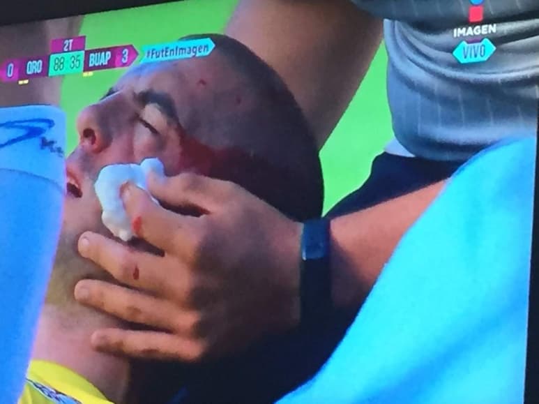 Lucero Álvarez salió lesionado del encuentro ante Gallos de Querétaro. Según el informe el arquero estuvo a punto de perder el ojo por una fractura de pómulo, sin embargo no pasó a mayores.