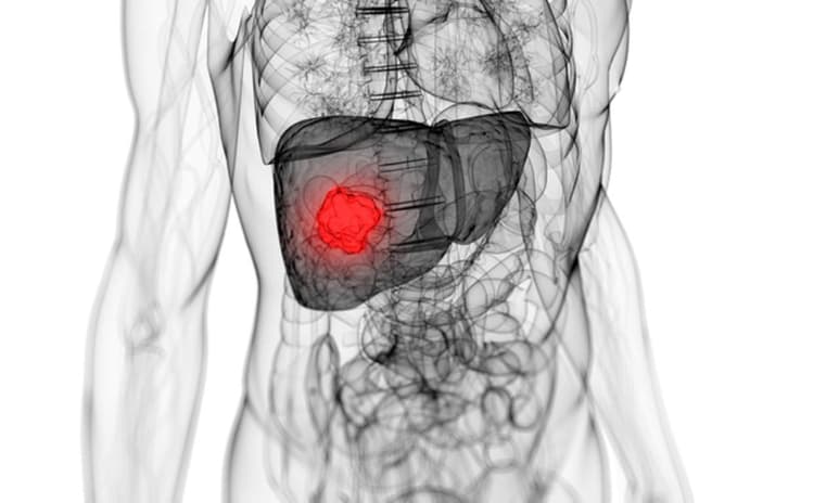 Alteraciones del hígado como lo es la cirrosis, conducen invariablemente a la necesidad de un trasplante con el fin de incrementar la calidad y expectativa de vida. (ARCHIVO)