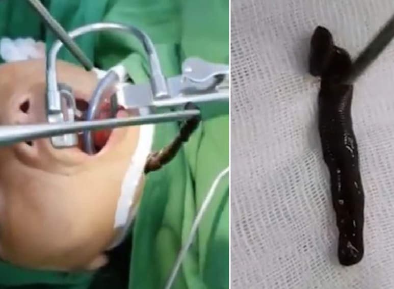 La sanguijuela estuvo en su garganta alrededor de 3 meses, aunque los doctores pensaron que era un tumor. (INTERNET)